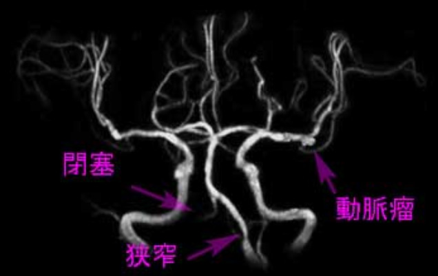 MRA(MRⅡによる血管撮影)